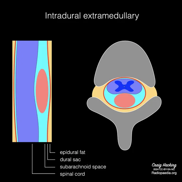 Intradural extramedullary spinal tumor diagram