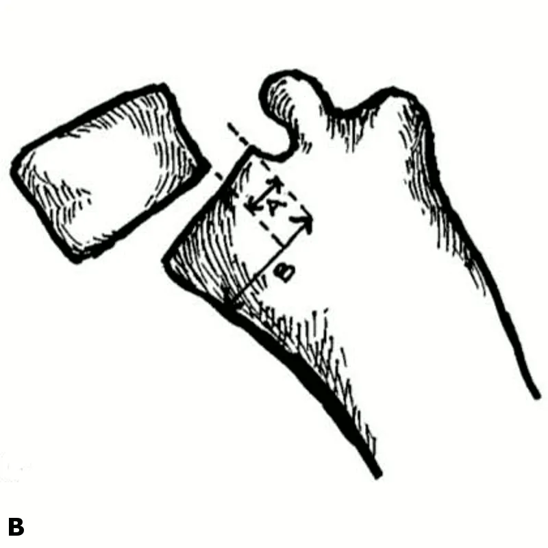 Meyerding classification of spondylolisthesis grades