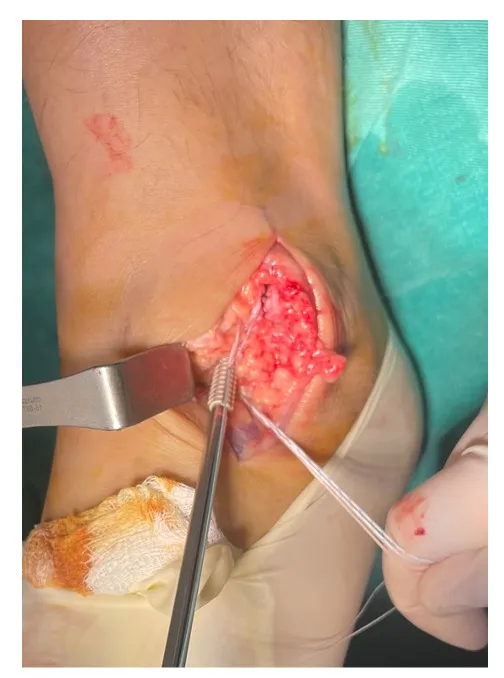 Brostrom-Gould surgical repair technique