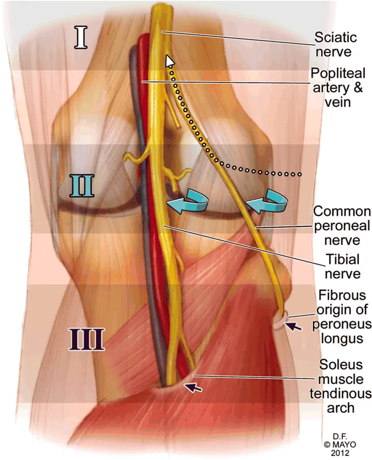 Knee Dislocation with Popliteal Artery and Peroneal Nerve