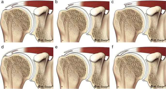 Rotator cuff tear classification diagram