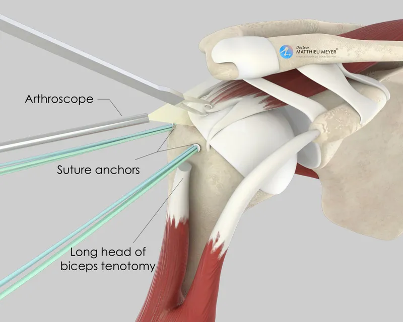 Arthroscopic Rotator Cuff Repair Technique