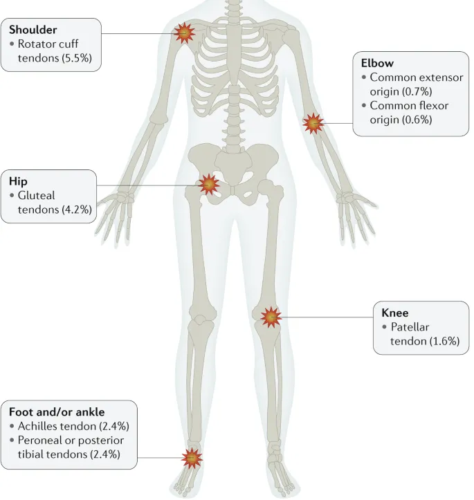 Common Tendinopathy Sites and Prevalence