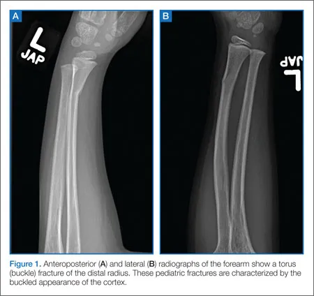Radiograph of pediatric torus fracture