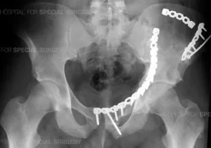 Pelvic fracture with ORIF plate and screws