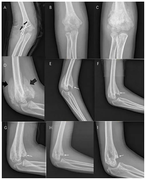 Myositis ossificans brachialis X-ray series