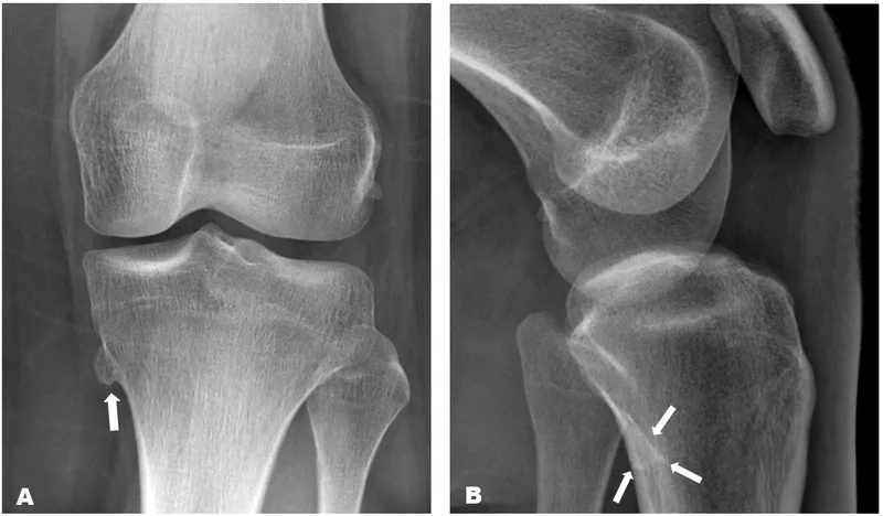 Osteochondroma X-ray knee AP and lateral views