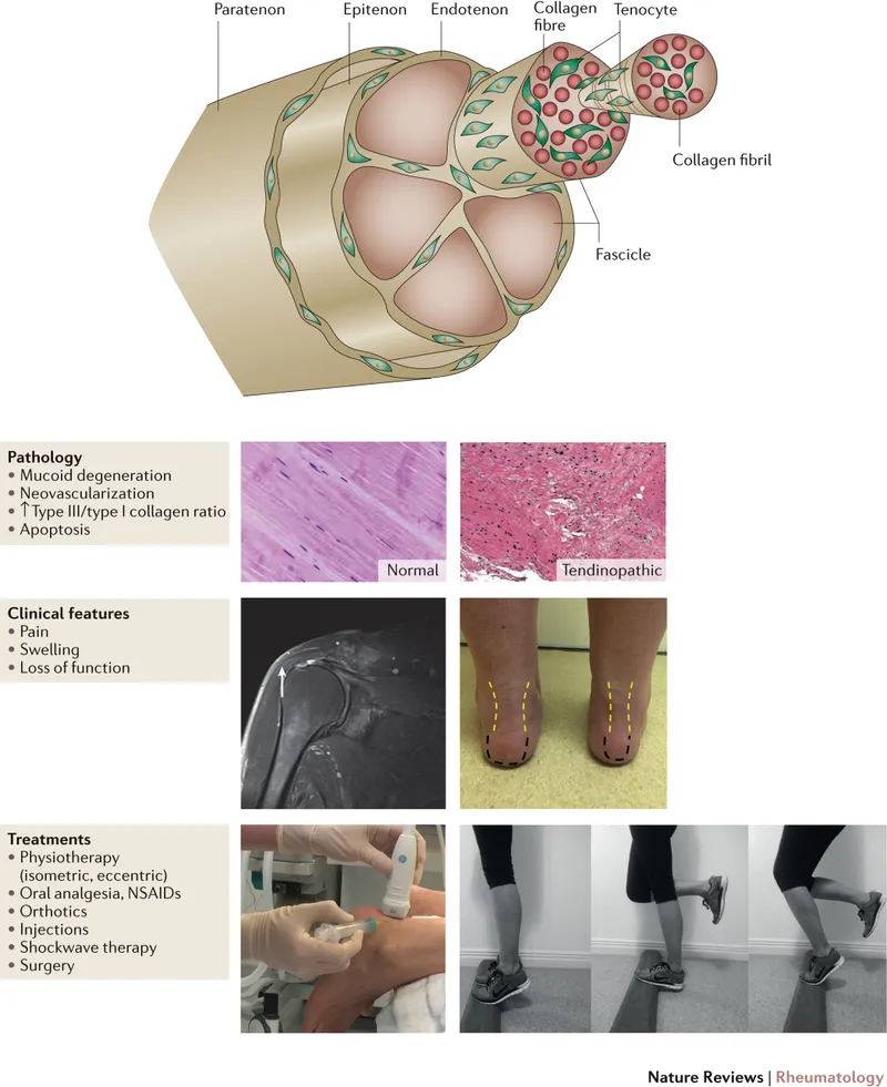 Tendinopathy: Pathology, Clinical Features, Treatments