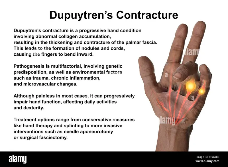 Dupuytren's Contracture Illustration