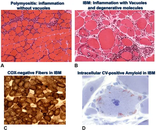 Histology of Polymyositis and Inclusion Body Myositis