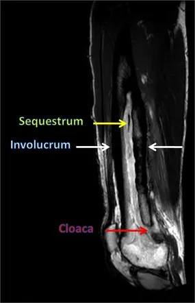 MRI of chronic osteomyelitis with sequestrum and involucrum