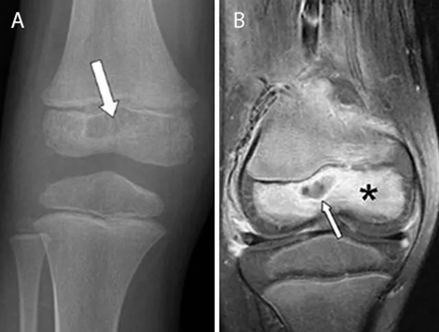 Osteomyelitis: X-ray vs. MRI