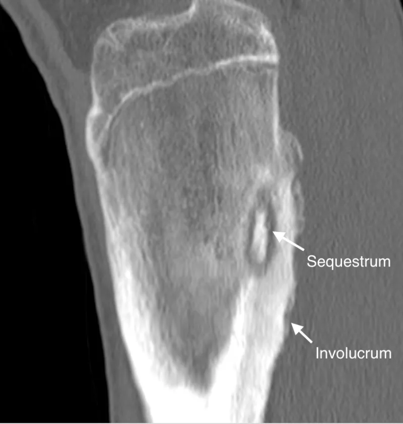 Chronic Osteomyelitis: Sequestrum and Involucrum on CT