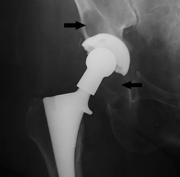 X-ray of hip implant with periprosthetic radiolucency
