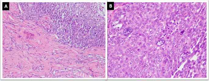 High-grade sarcoma histology: pleomorphism and mitoses