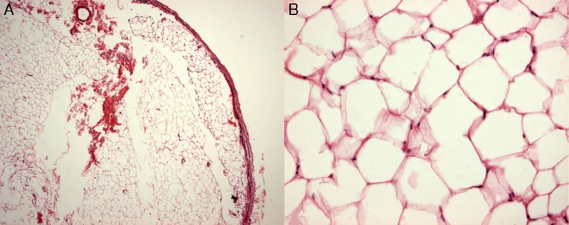 Histology of lipoma showing mature adipocytes