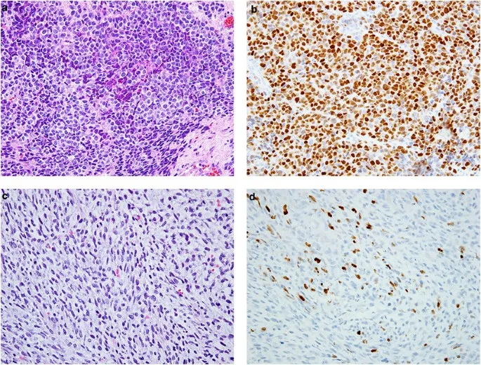 Immunohistochemistry of Soft Tissue Sarcoma