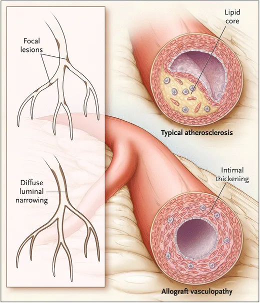 Allograft Vasculopathy vs Atherosclerosis
