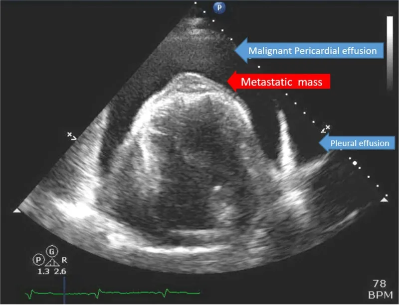 Echocardiogram: Metastatic mass and effusions
