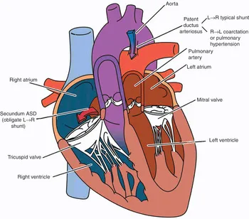 ASD, PDA, VSD locations and L-R shunt direction