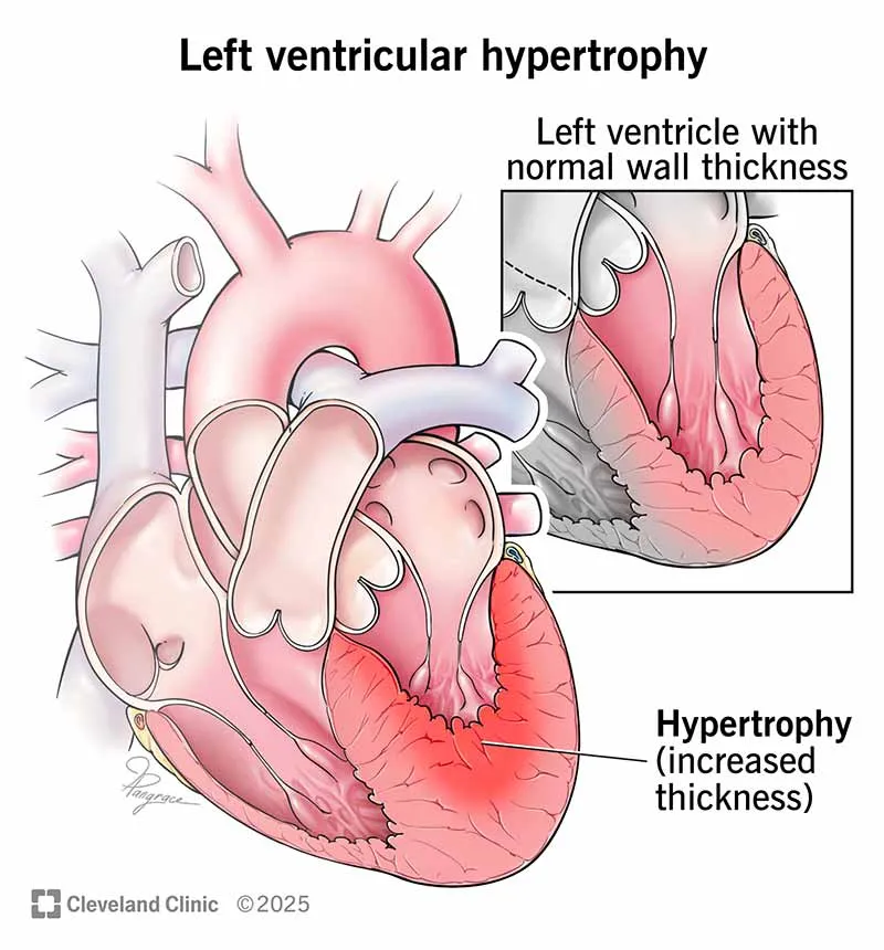 Left ventricular hypertrophy vs normal heart