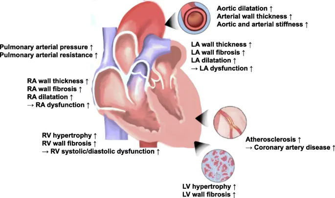 Hypertensive Heart Disease Cardiac Changes Diagram