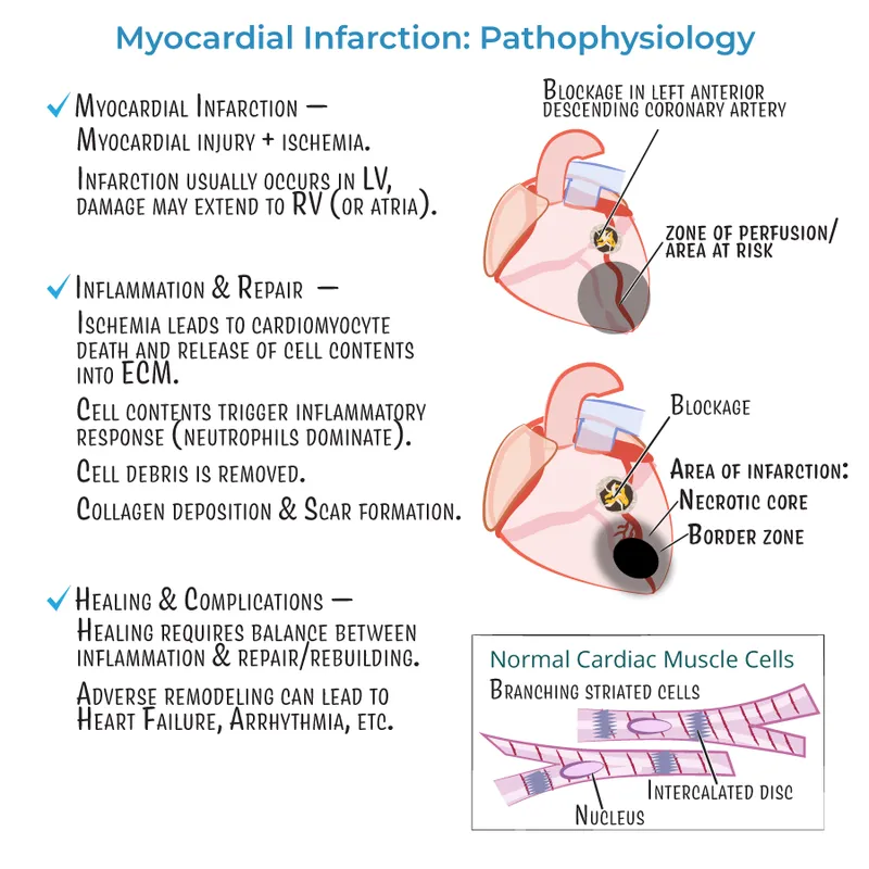 Myocardial Infarction Pathophysiology