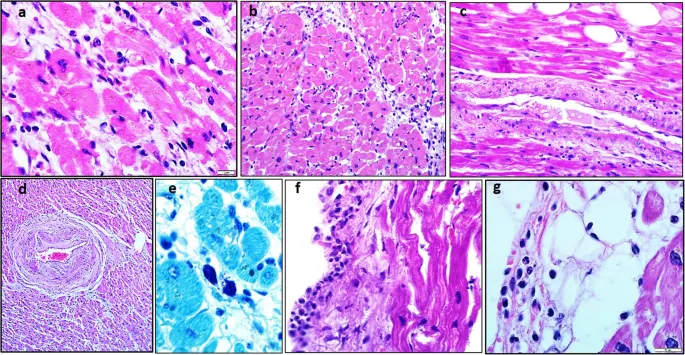 Myocarditis Histology