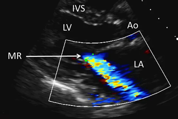 Echocardiogram showing mitral regurgitation jet