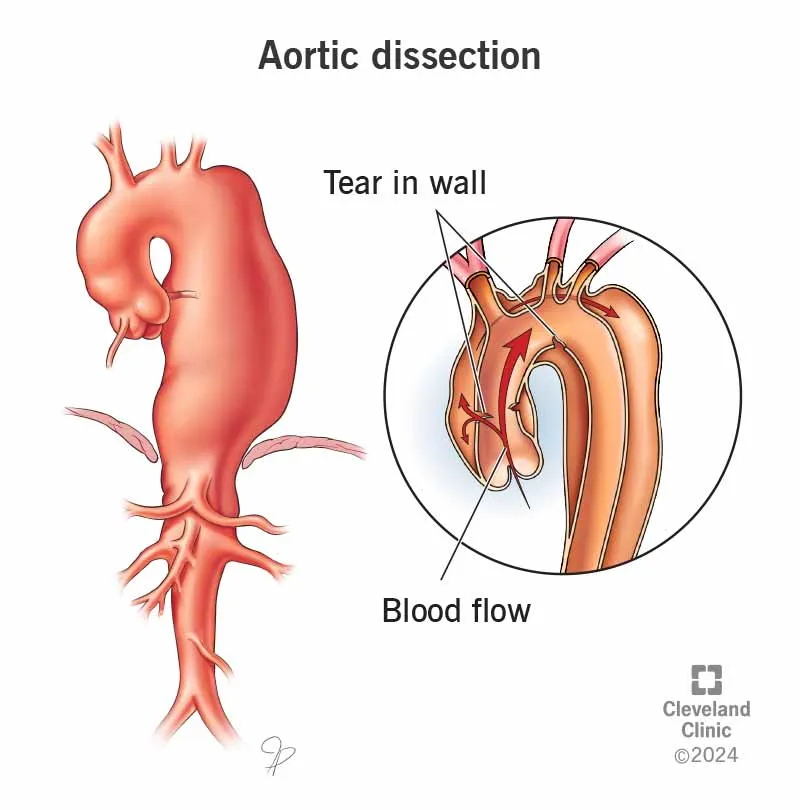 Aortic dissection with tear in wall and blood flow