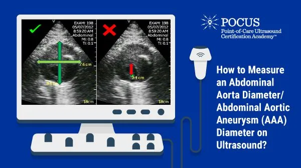 Measuring Abdominal Aortic Aneurysm (AAA) on Ultrasound