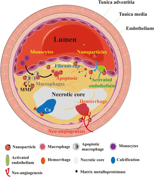 Atherosclerotic Plaque with Fibrous Cap and Necrotic Core