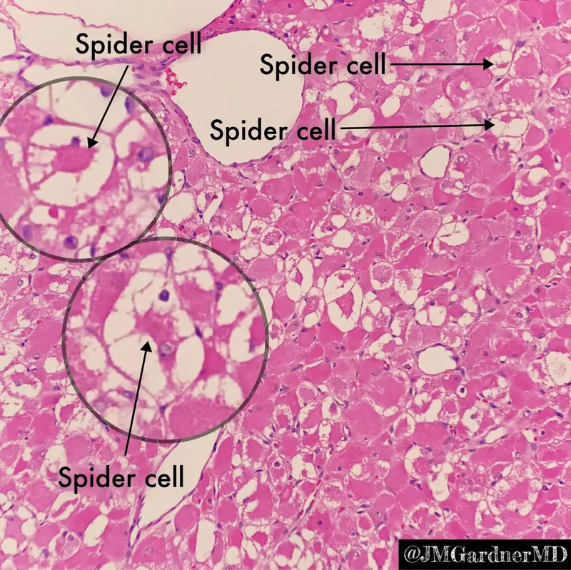 Cardiac Rhabdomyoma Histopathology with Spider Cells