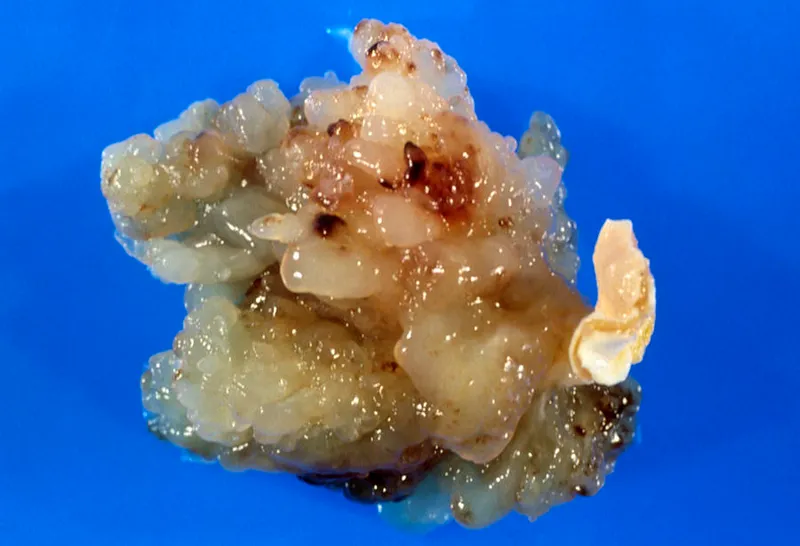 Atrial Myxoma Gross Specimen