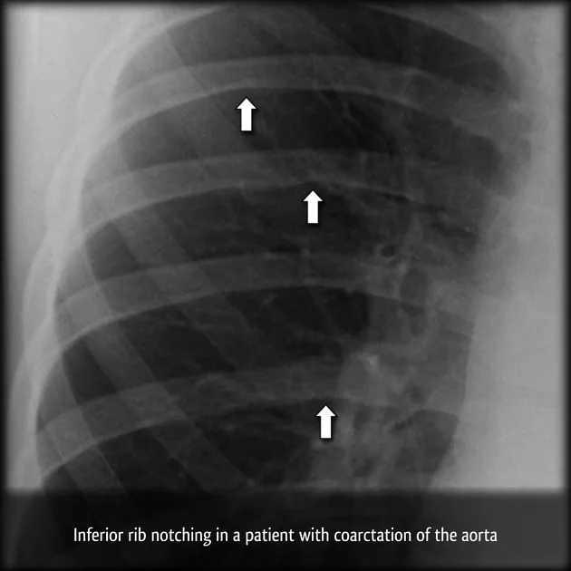 X-ray: Rib Notching in Coarctation of the Aorta