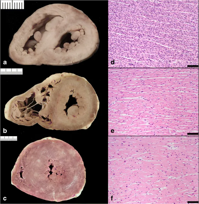 Hypertensive Heart Disease: Gross and Microscopic Views