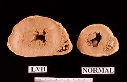 LVH vs. Normal Heart: Gross Specimen Comparison