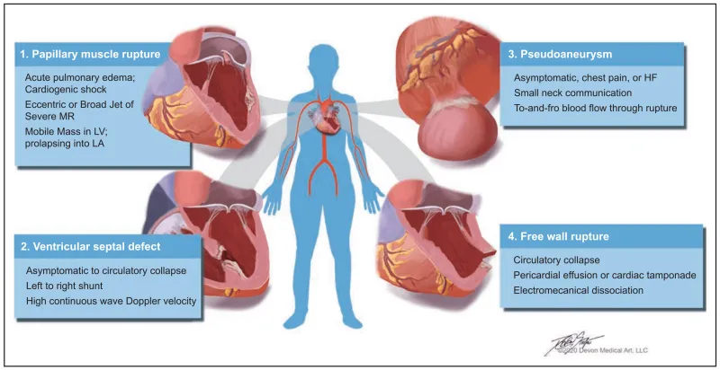 Post-MI Cardiac Rupture Locations and Clinical Features