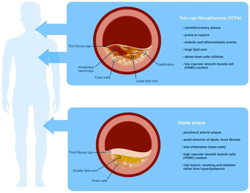 Stable vs. Unstable Atherosclerotic Plaque Comparison