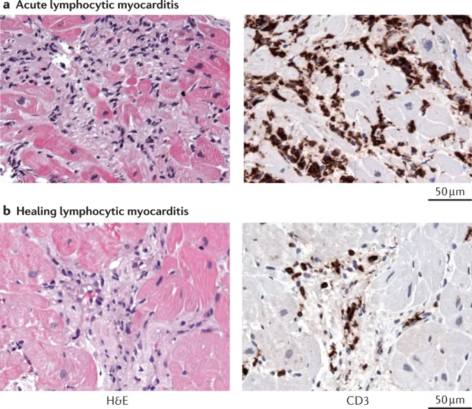 Acute vs. Healing Lymphocytic Myocarditis Histopathology
