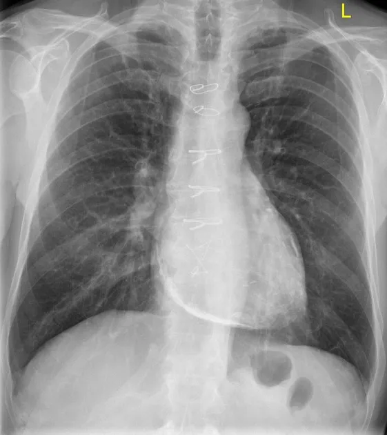 Chest X-ray with sternal wires, no pericardial calcification