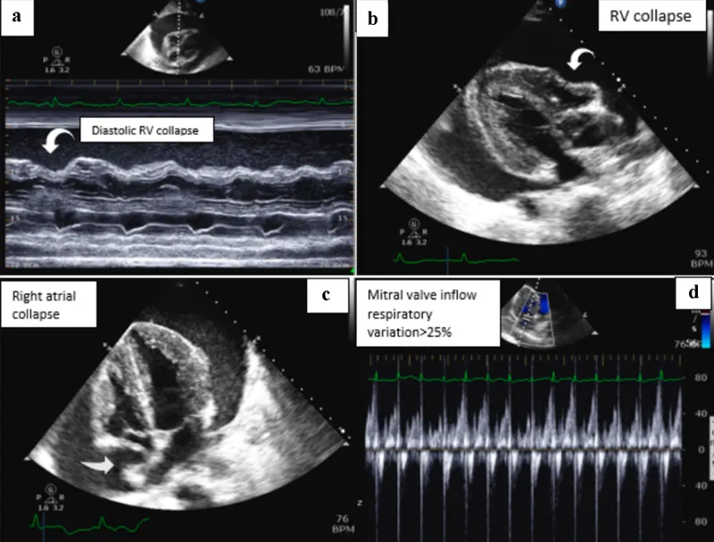 Echocardiogram: Pericardial Effusion & Cardiac Tamponade