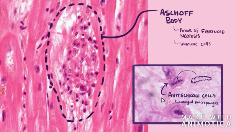 Aschoff body and Anitschkow cells in rheumatic heart disease