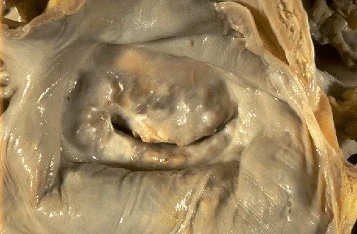 Rheumatic Heart Disease: "Fish-Mouth" Mitral Valve