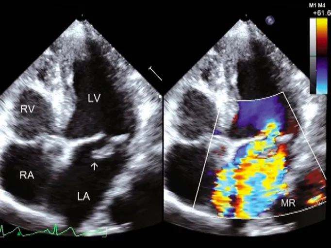 Echocardiogram showing mitral stenosis and regurgitation