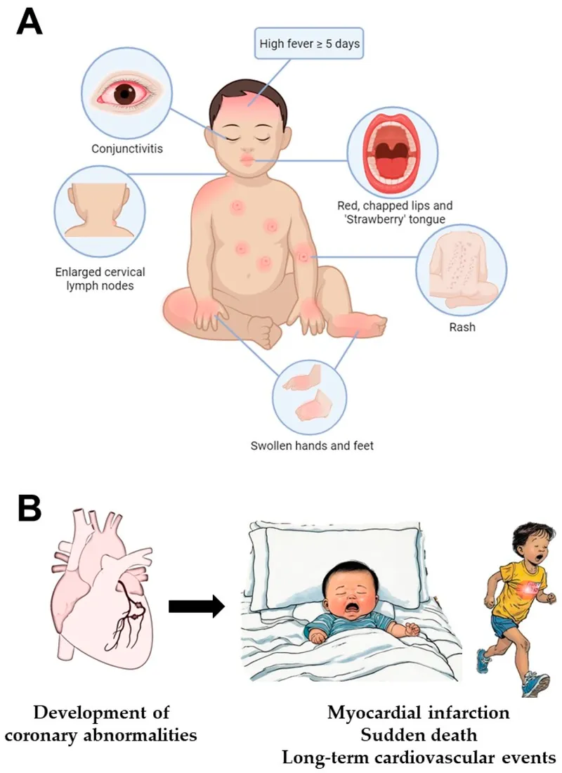 Kawasaki Disease: Symptoms and Cardiac Complications