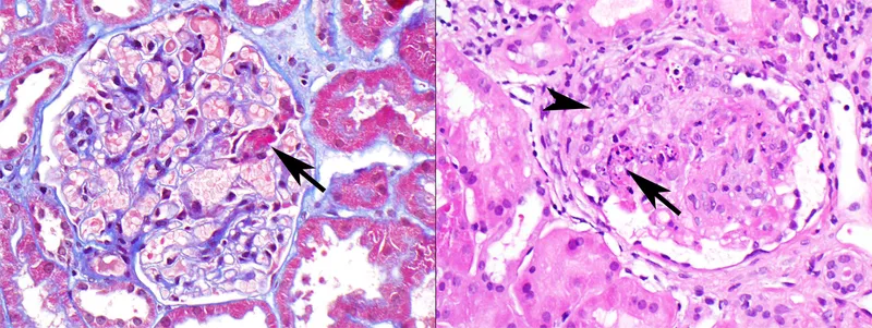 Pauci-immune crescentic glomerulonephritis histology