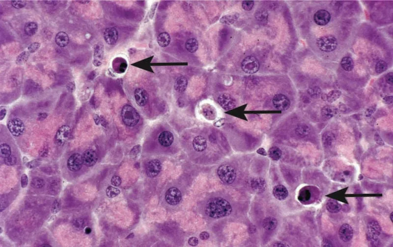 Apoptotic cells with pyknosis and karyorrhexis
