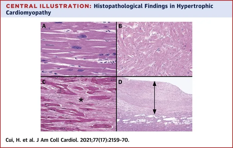 Histopathology of Hypertrophic Cardiomyopathy
