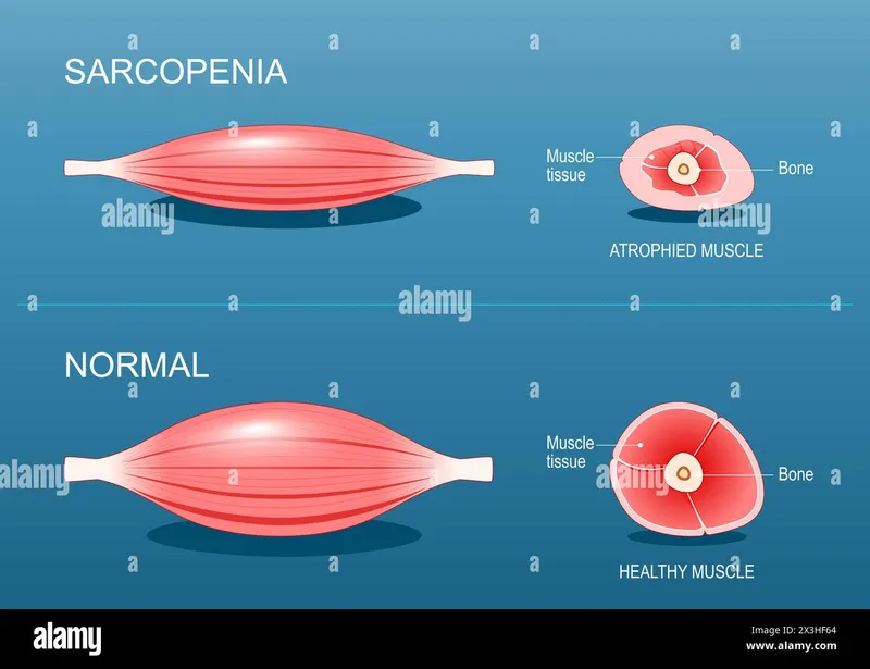 Sarcopenia vs. Normal Muscle